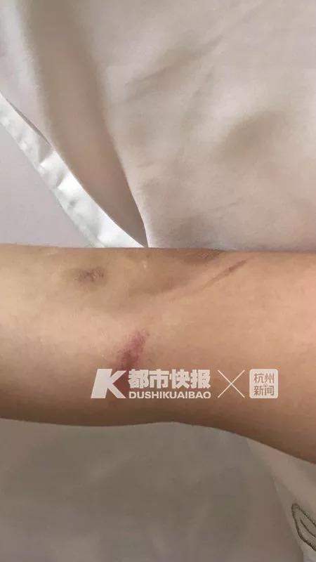 　小美身上的傷痕