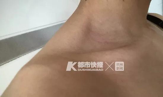 女客戶身上的傷痕