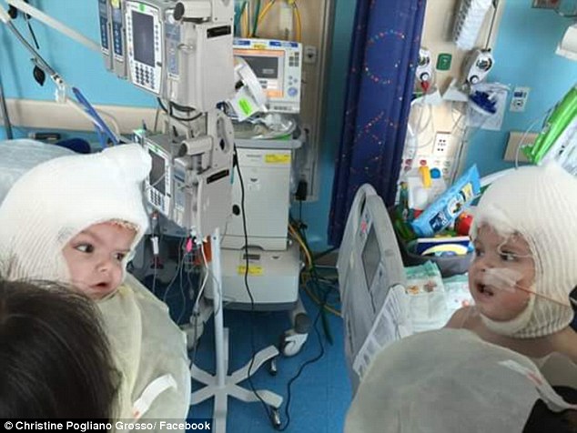 连体婴儿经过27个小时的手术后 第一次看到了对方