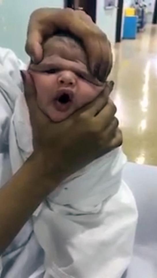 残忍！护士挤压婴儿的头取乐 孩子整张脸变形