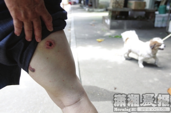 6月21日,湘仪家园小区,龚先生展示被狗咬伤的伤痕。 图/记者华剑