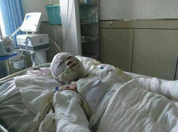 全身烧伤的倪嘉俊