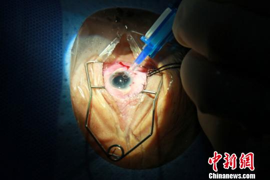 折叠型后房型人工晶体植入后旋即打开，患者相当于更换了眼睛浑浊了的光学部件，得以复明。　关向东 摄