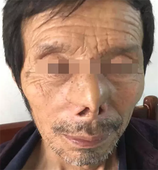 手术两年后,老人的鼻子外貌和功能恢复