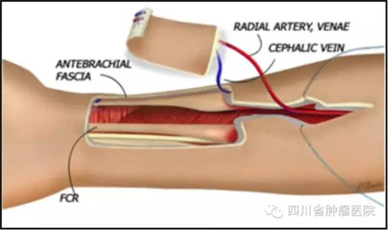 前臂皮瓣示意图1
