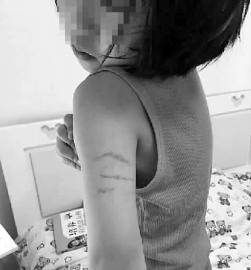 女孩手臂上的伤痕N11