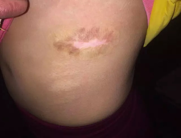 女孩腹部疤痕。图片来自网络