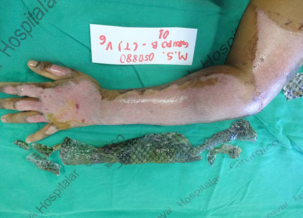 巴西女子手臂烧伤后植入鱼皮 科学家为烧伤病人治疗的第一次尝试