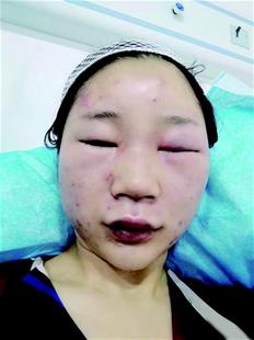 华师女生昆明旅游 街头莫名被打后脑勺缝了6针