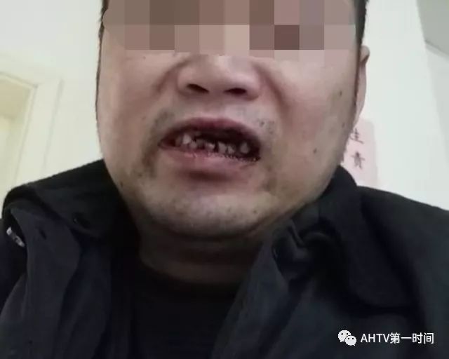 合肥:火车站内起纠纷,被保安打掉五颗牙?