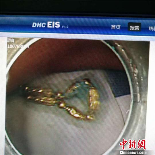 女子因怄气“吞金自杀”胃里取出10厘米金项链
