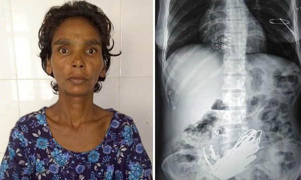 印度女子腹痛 医生竟取出3公斤金属
