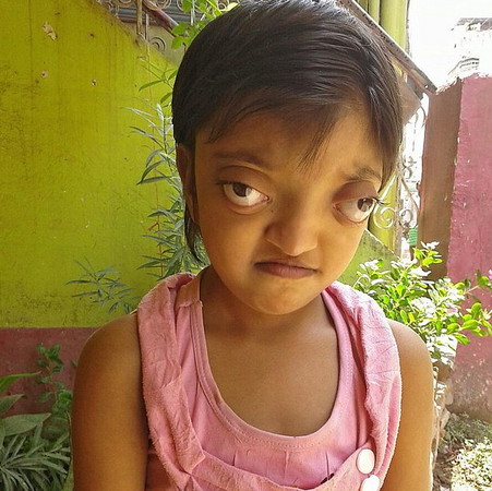 印度女孩眼睛外凸如青蛙被嘲笑外星人图