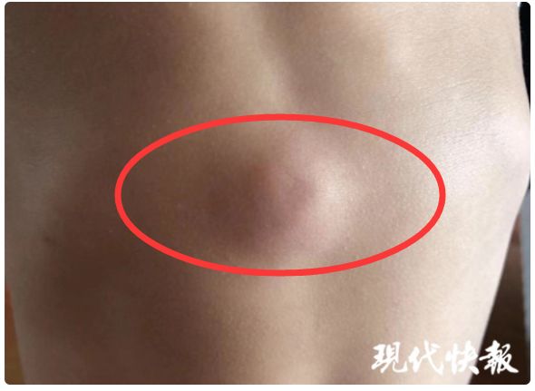 3岁男孩身上包块竟会动医生划开一看所有人震惊了