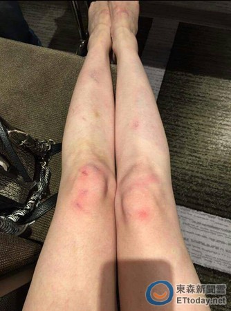腿太细的女生受伤图片