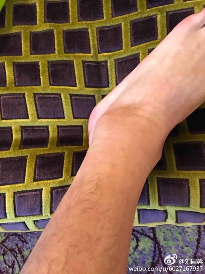 此前刚刚抵达卡塔尔张继科的脚便肿了起来此前刚刚抵达卡塔尔张继科的