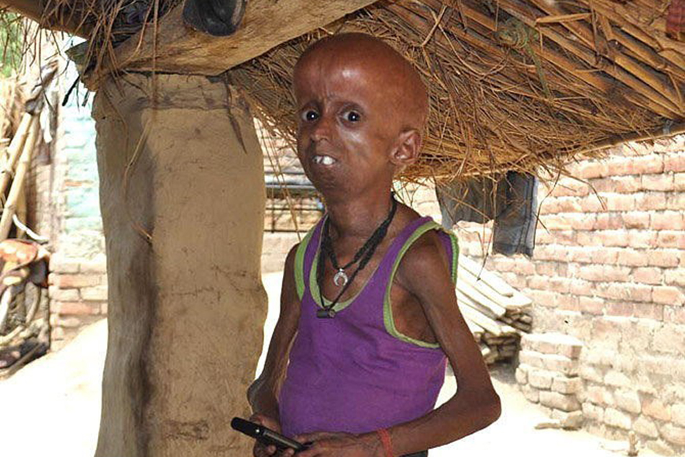 21岁印度青年患罕见早衰症 拥有160岁老人身体