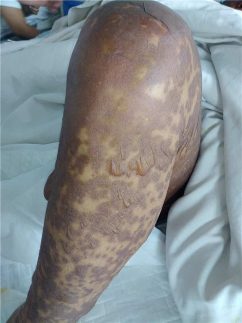 单亲父亲拉扯大儿女却患上怪病 网友展开救助行动