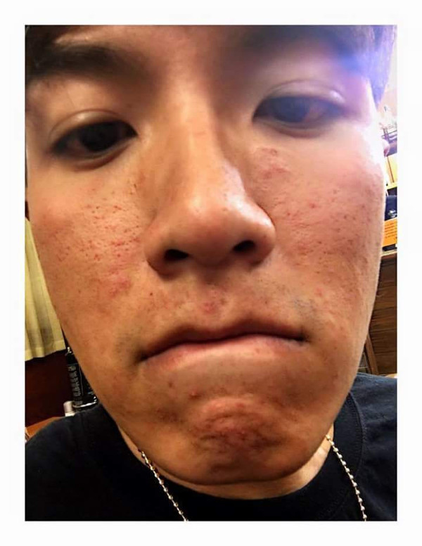 水土不服导致的皮肤过敏怎么办 水土不服导致的皮肤过敏的护理