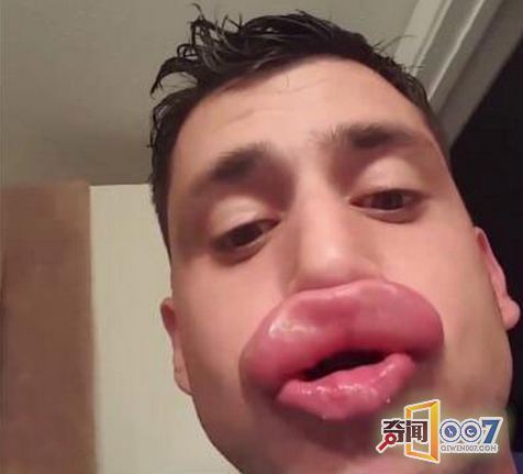 男子无钱整容 抓来黄蜂将自己嘴唇蛰成"香肠唇"