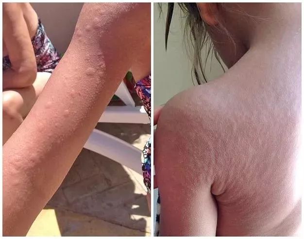 5. 接种水痘疫苗后15天产生抗体,30天时抗体水平达到高峰,免疫力持久.