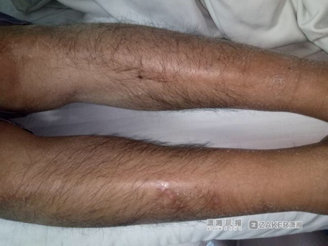 男子全身皮肤僵硬似木头因患罕见僵尸病