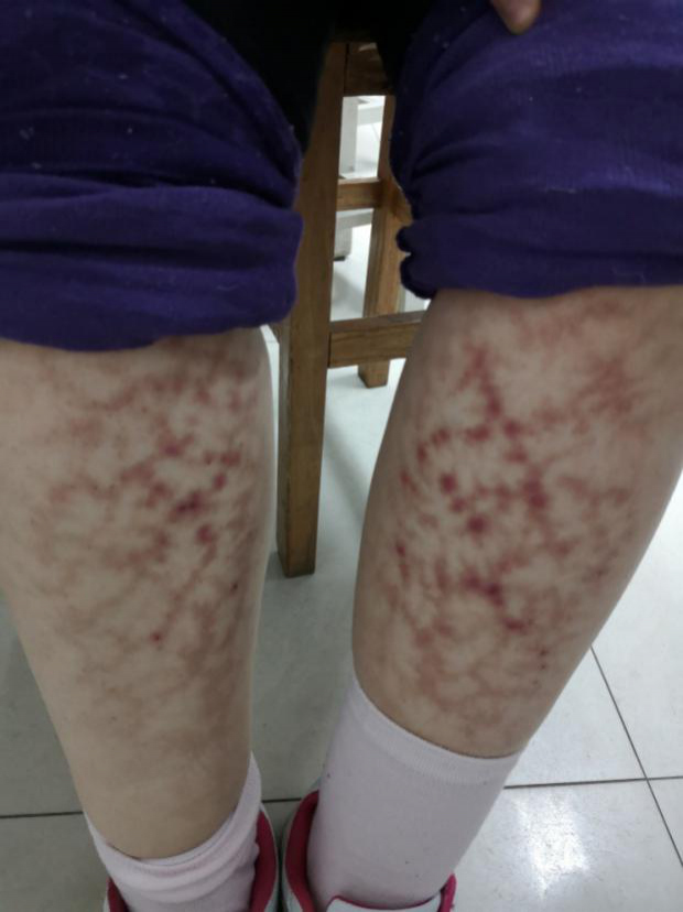 近日,长沙市民李女士觉得自己的小腿总有瘙痒感