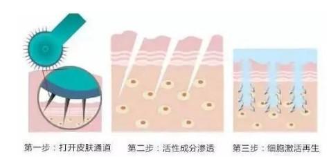 点阵激光