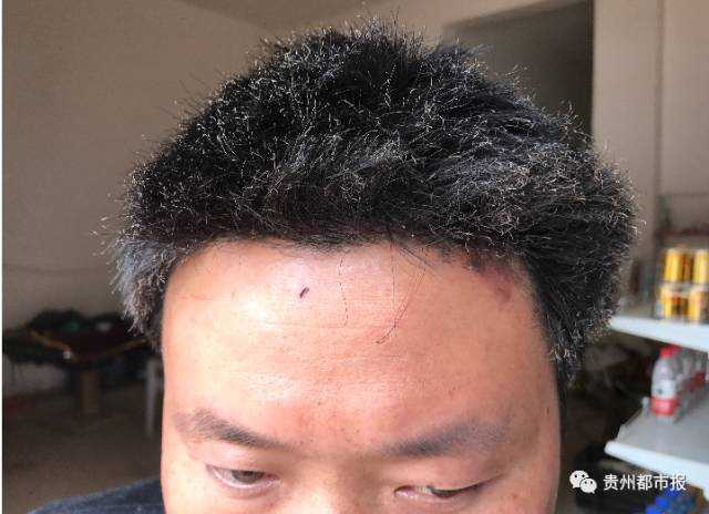 一声巨响 床边充电的手机炸了,5岁女童遭毁容